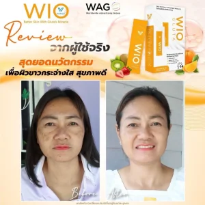 รีวิว WIO Gluta ลดฝ้า กระ ผิวเนียน ผิวกระจ่างใส